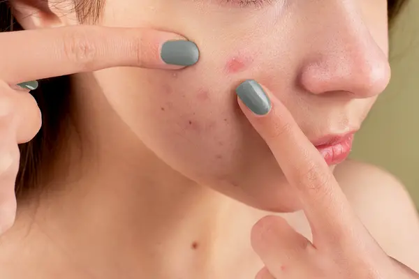 Controls acne